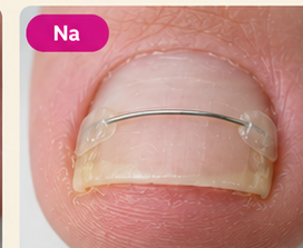 Voorbeeld van een geplaatste nagelbeugel