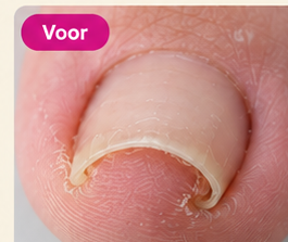 Voorbeeld voor het plaatsen van een nagelbeugel