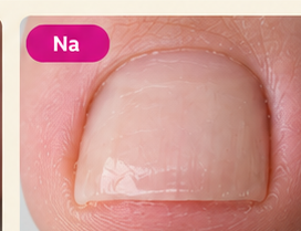 Voorbeeld van een nagel na een nagelreconstructie